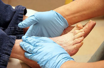 Diabetic foot treatment and care in the Brooklyn, NY 11229 and Astoria, NY 11103 areas