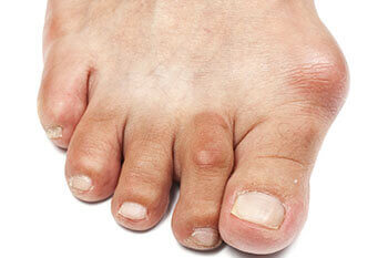 Bunions Treatment in the Brooklyn, NY 11229 and Astoria, NY 11103 areas