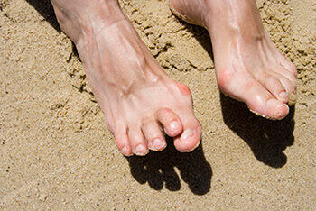 Hammertoes & Mallet Toes treatment in the Brooklyn, NY 11229 and Astoria, NY 11103 areas