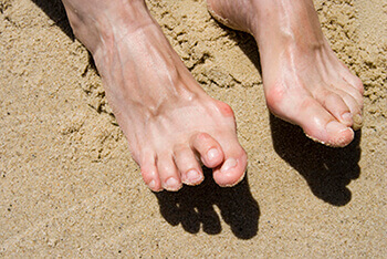 Hammertoes & Mallet Toes treatment in the Brooklyn, NY 11229 and Astoria, NY 11103 areas