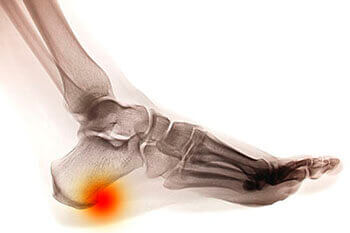 Heel spurs treatment in the Brooklyn, NY 11229 and Astoria, NY 11103 areas