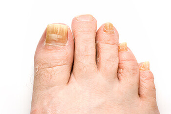 Fungal toenails diagnosis and treatment in the Brooklyn, NY 11229 and Astoria, NY 11103 areas