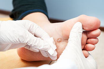 Plantar warts treatment in the Brooklyn, NY 11229 and Astoria, NY 11103 areas