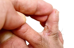 Athlete’s Foot and How to Protect Your Skin