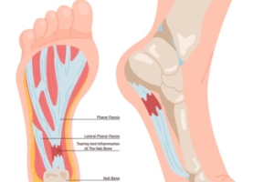 Plantar Fasciitis and Footwear Choices