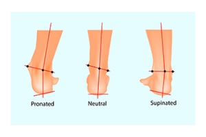 Causes and Treatment of Overpronation