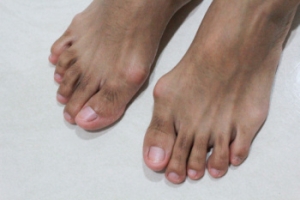 Bunions and Running